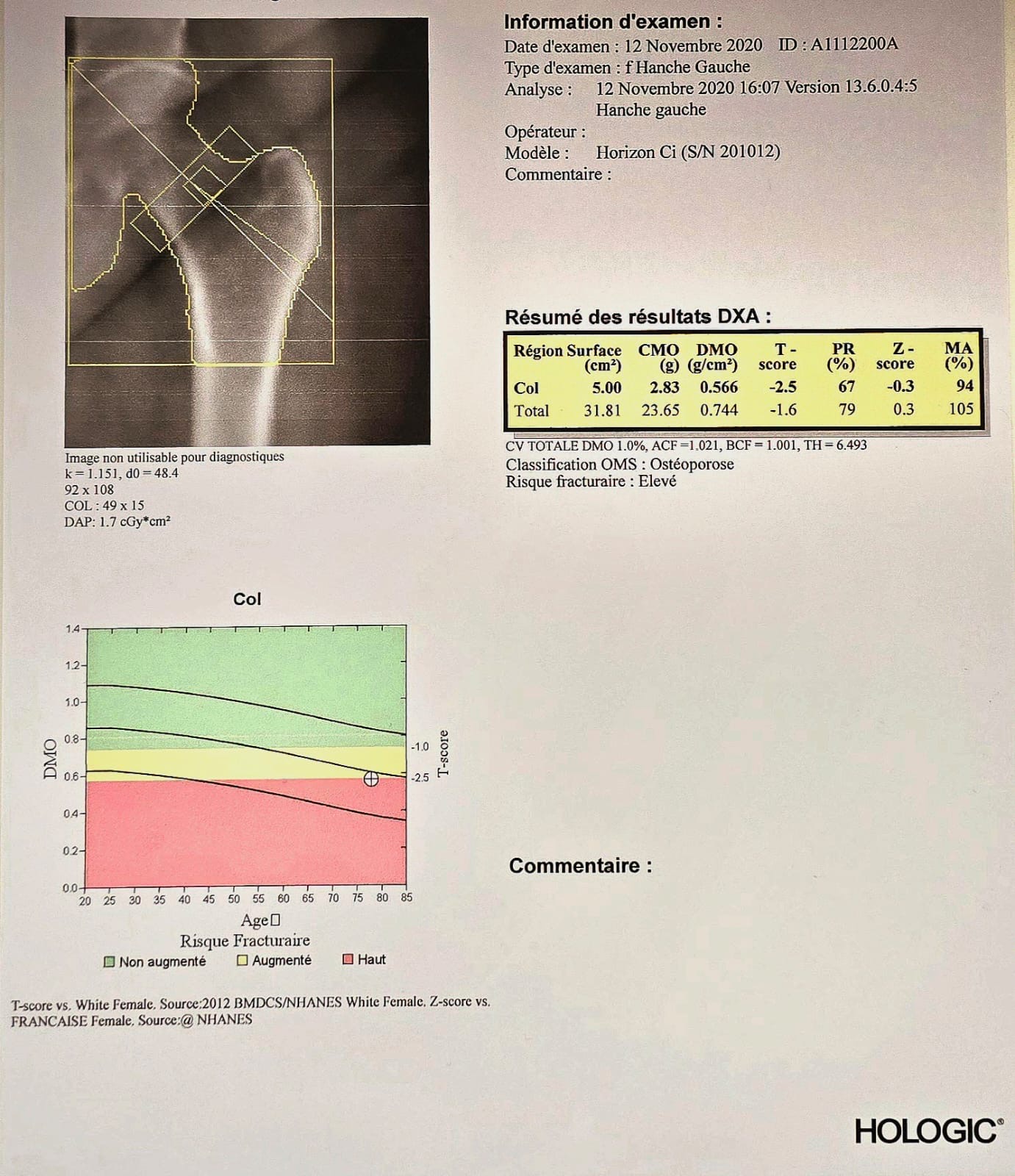 osteodensitometrie